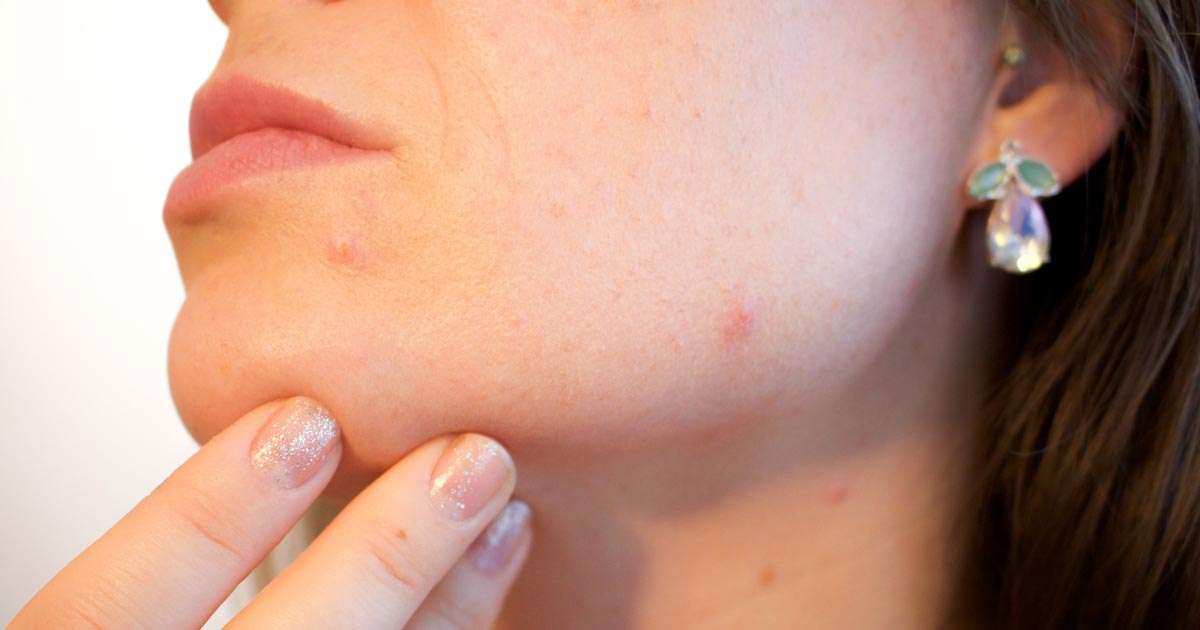 Best Acne Treatment For Adults – How To Determine The Right One