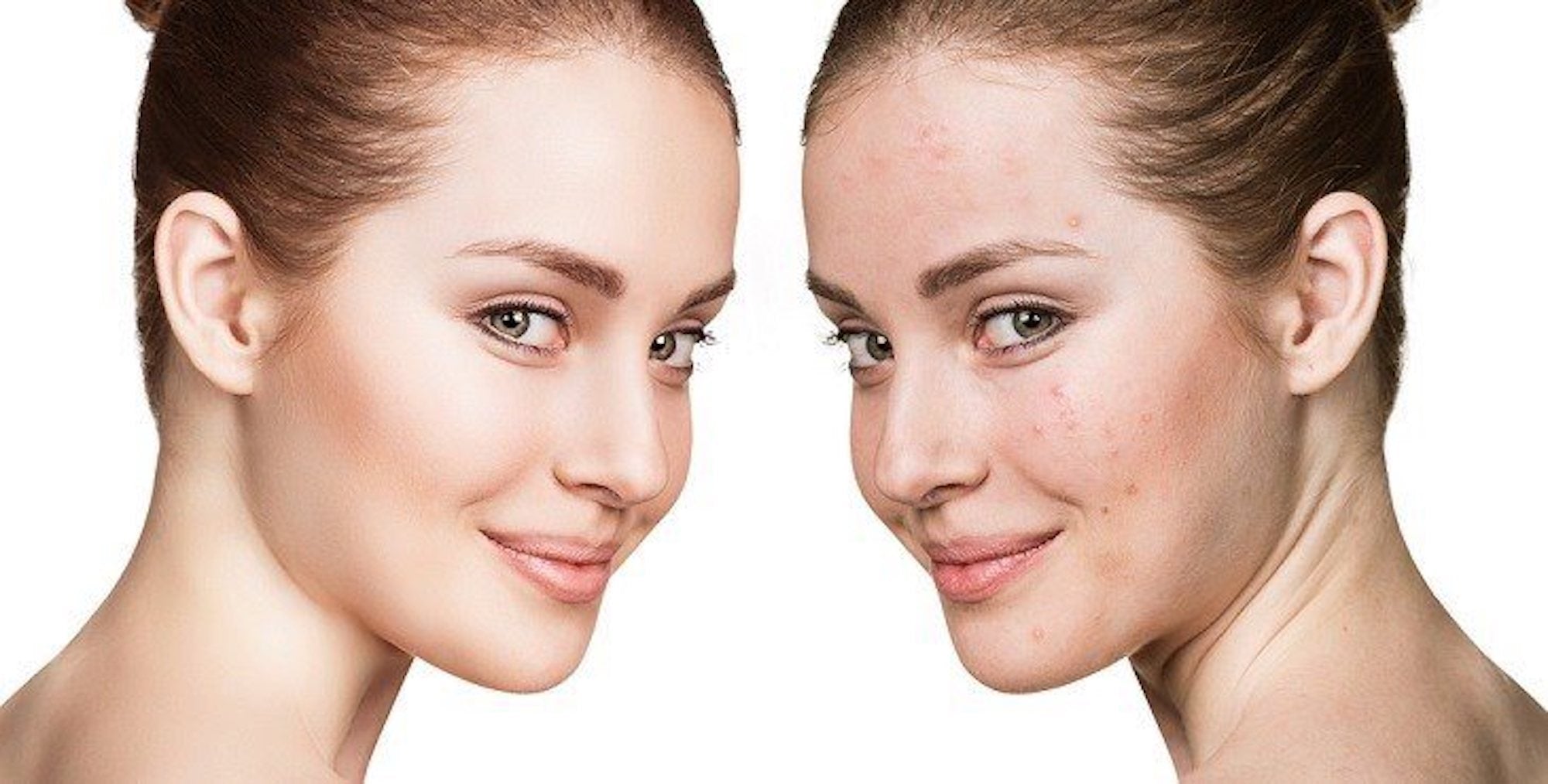 Best skincare routine for acne-prone skin