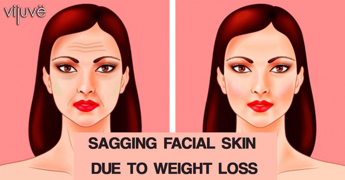 Sagging Facial Skin Due To Weight Loss