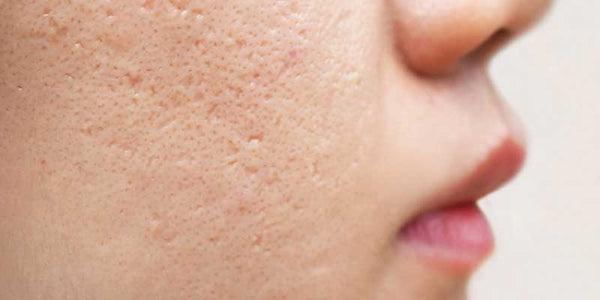 How To Determine The Right Acne Treatment For Adult Skin