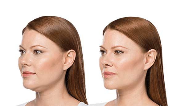 How to lose skin fat under the chin